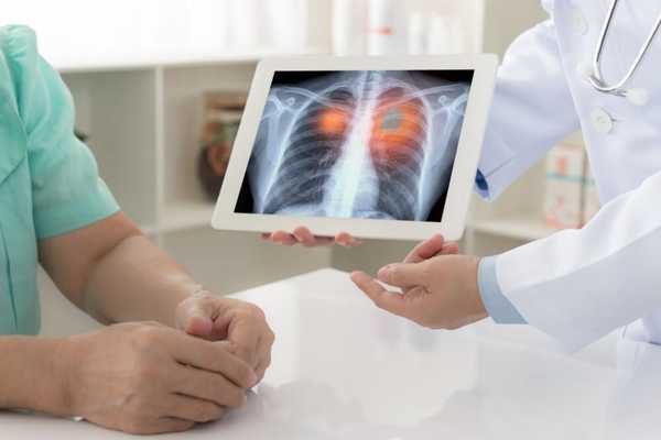 Lung Cancer Therapy: Current Treatments and Innovations in Care