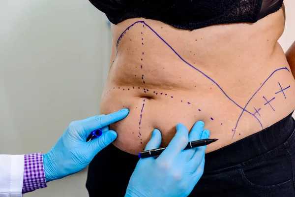 Tummy Tuck Clinical Trials: Your Path to Compensation and Cutting-Edge Research