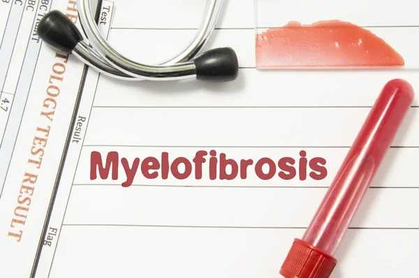 Understanding Myelofibrosis: Symptoms, Causes, and Cutting-Edge Treatments