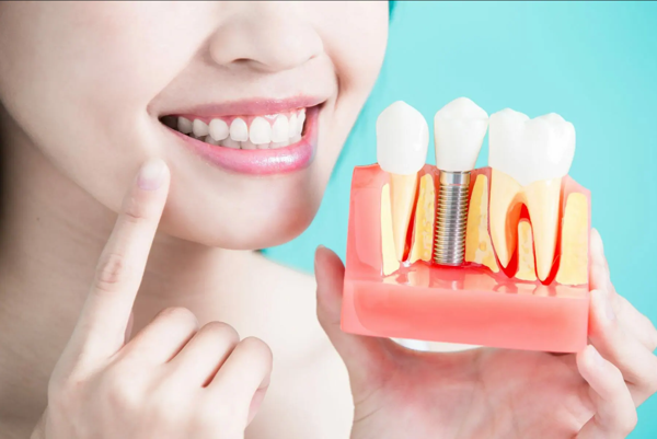 How to Make Dental Implants Fit Your Budget: Tips and Tricks Revealed